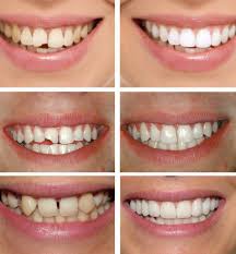 byugelnoe-protezirovanie-perednih-zubov3