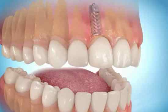 implantaciya-zuba