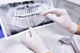 lechenie-kornevyh-kanalov-pri-hronicheskom-periodontite